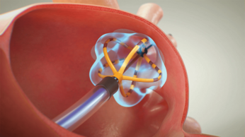 パルスフィールドアブレーション